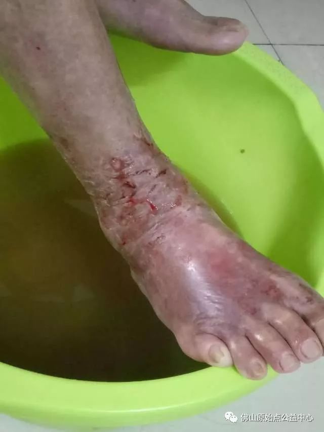 原始点调理全身肿胀溃烂：九个月，雨过天睛 - 皮肤 - 佛山市愿天下无痛健康管理服务有限公司