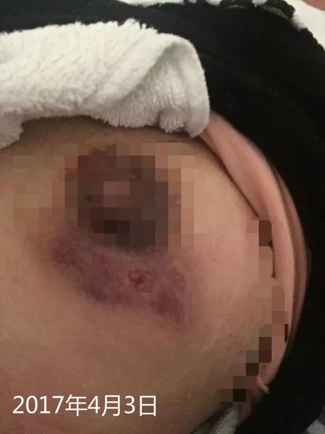 原始点调理乳房溃烂：一位德国媳妇飞越半球的原始点求医经历 - 乳腺增生  乳腺癌 - 佛山市愿天下无痛健康管理服务有限公司