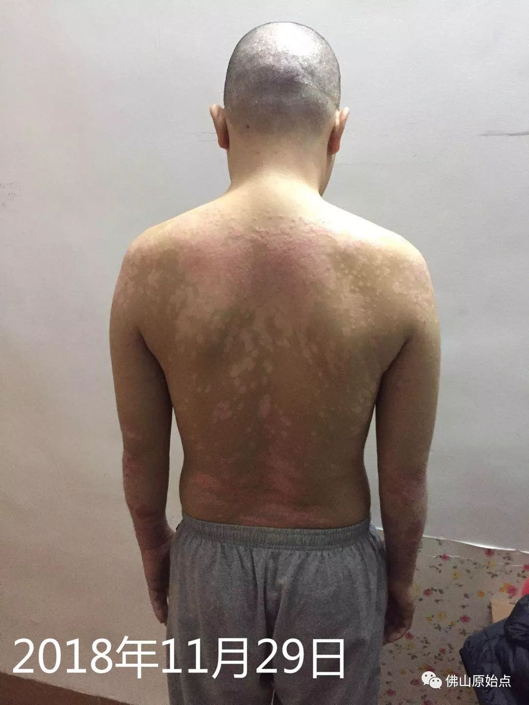 原始点调理牛皮癣案例 - 皮肤 - 佛山市愿天下无痛健康管理服务有限公司
