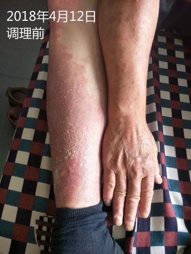 原始点调理十五年病史牛皮癣：30天大变样 - 皮肤 - 佛山市愿天下无痛健康管理服务有限公司