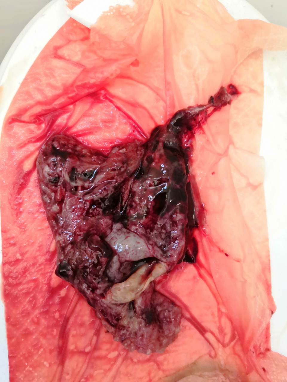 原始点调理胎死腹中案例 - 妇产   - 佛山市愿天下无痛健康管理服务有限公司