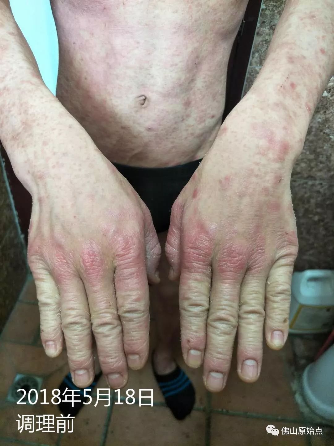 原始点调理严重牛皮癣及静脉曲张：84天完好如初 - 皮肤 - 佛山市愿天下无痛健康管理服务有限公司