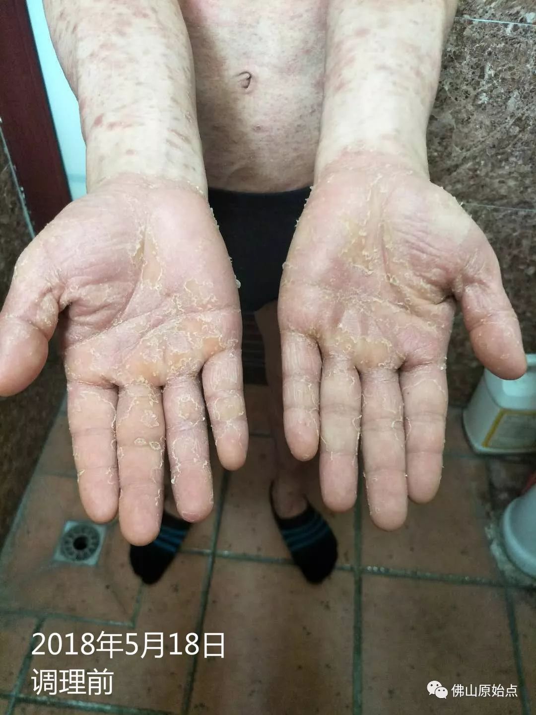 原始点调理严重牛皮癣及静脉曲张：84天完好如初 - 皮肤 - 佛山市愿天下无痛健康管理服务有限公司