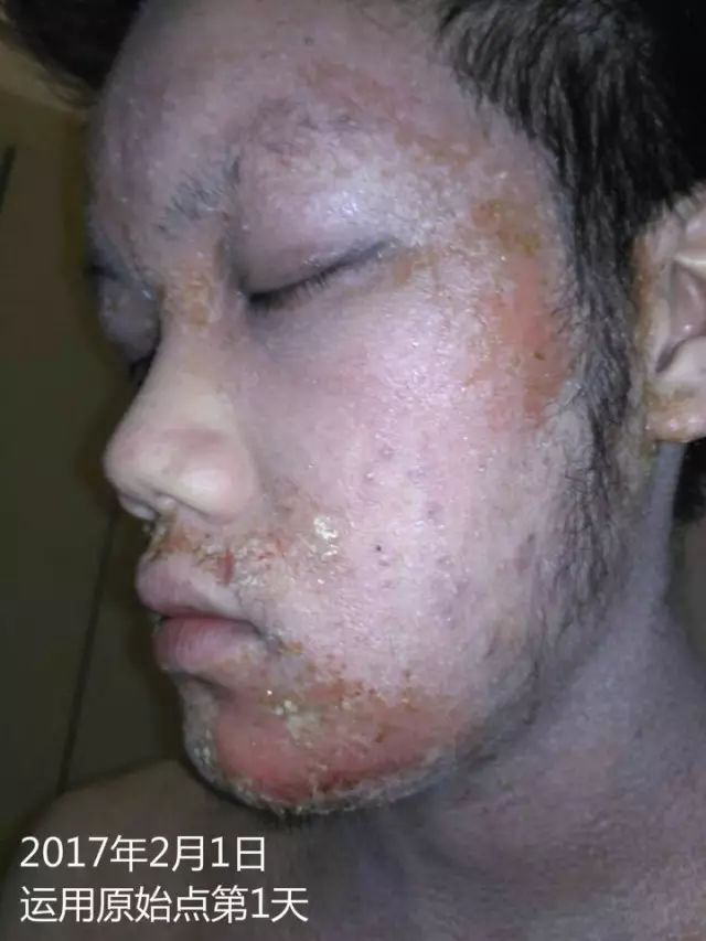 原始点21天调理23年严重湿疹案例 - 皮肤 - 佛山市愿天下无痛健康管理服务有限公司