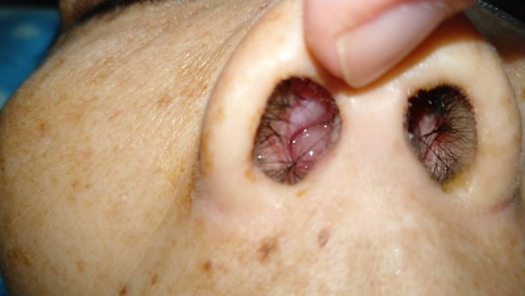 原始点调理鼻息肉案例 - 头颈  五官 - 佛山市愿天下无痛健康管理服务有限公司