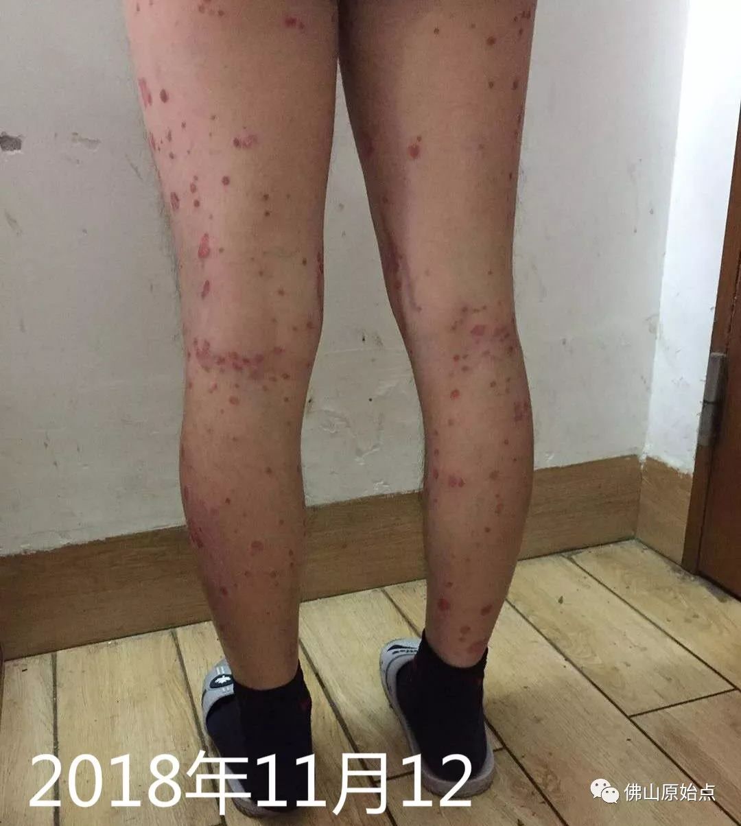 原始点调理牛皮癣案例 - 皮肤 - 佛山市愿天下无痛健康管理服务有限公司