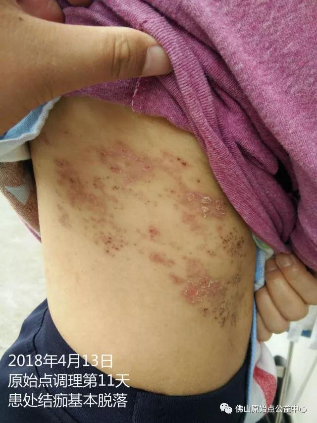 原始点调理带状疱疹：12天恢复+意外收获 - 皮肤 - 佛山市愿天下无痛健康管理服务有限公司