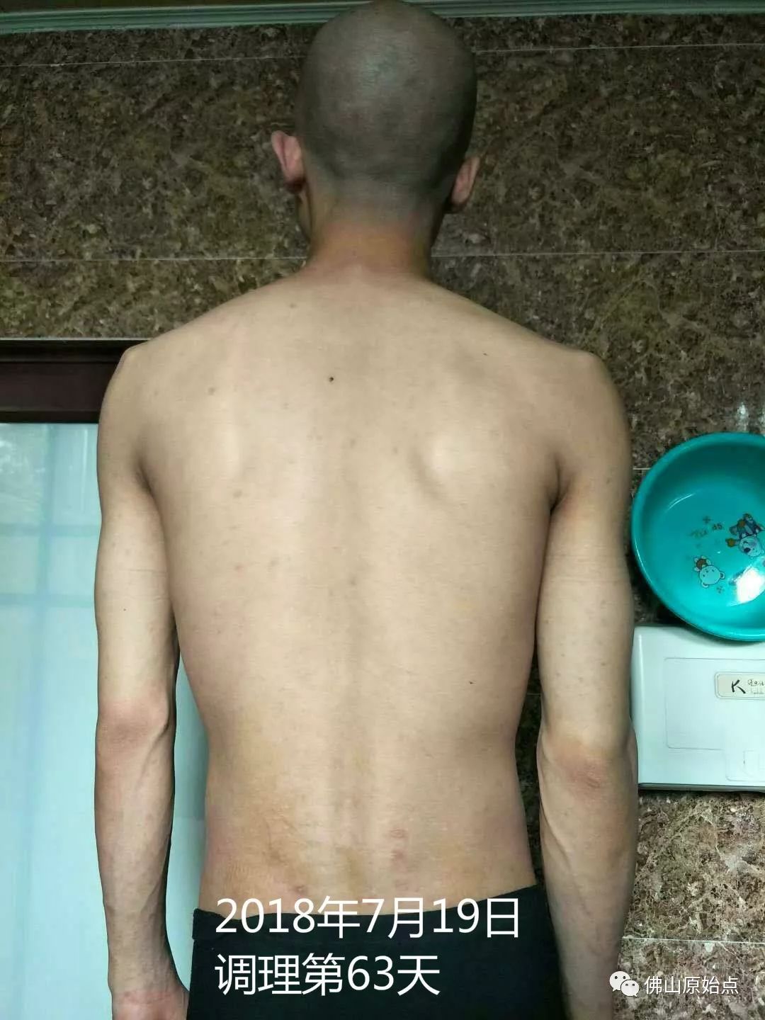 原始点调理严重牛皮癣及静脉曲张：84天完好如初 - 皮肤 - 佛山市愿天下无痛健康管理服务有限公司