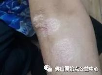 原始点调理九年史牛皮癣：二十天大变化 - 皮肤 - 佛山市愿天下无痛健康管理服务有限公司