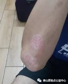 原始点调理九年史牛皮癣：二十天大变化 - 皮肤 - 佛山市愿天下无痛健康管理服务有限公司