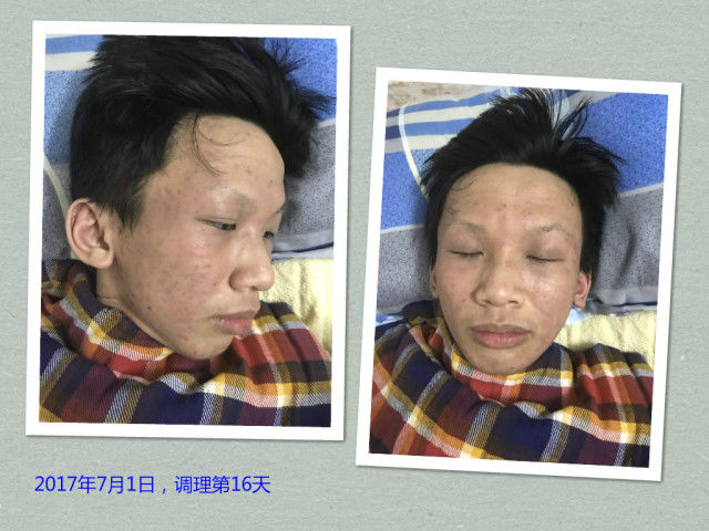 原始点调理严重湿疹：找回帅气的自己 - 皮肤 - 佛山市愿天下无痛健康管理服务有限公司