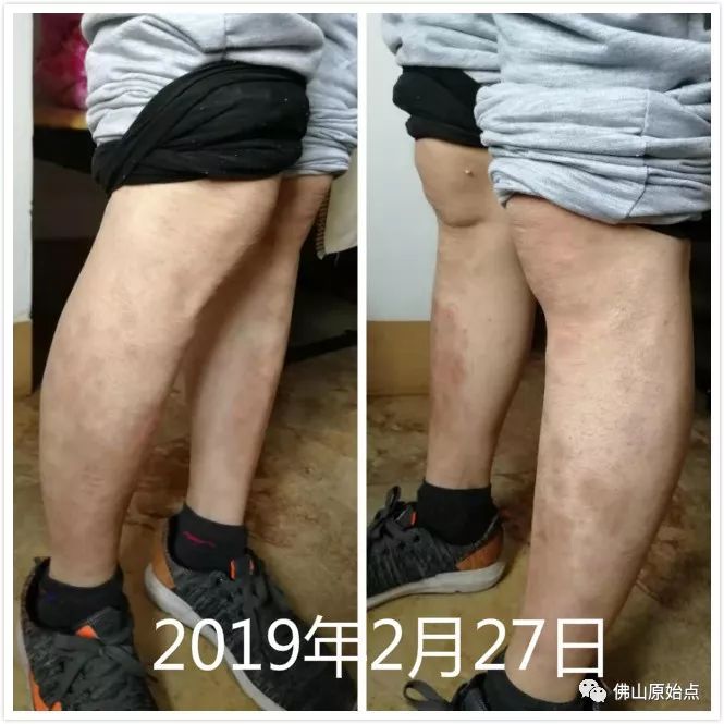 原始点调理牛皮癣案例 - 皮肤 - 佛山市愿天下无痛健康管理服务有限公司