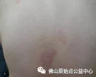 原始点调理九年史牛皮癣：二十天大变化 - 皮肤 - 佛山市愿天下无痛健康管理服务有限公司