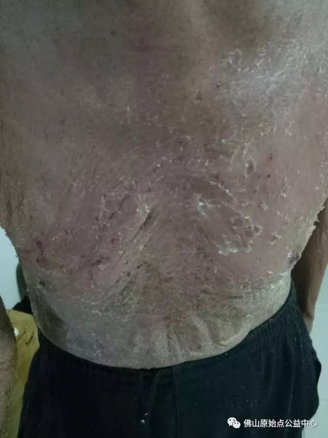 原始点调理全身肿胀溃烂：九个月，雨过天睛 - 皮肤 - 佛山市愿天下无痛健康管理服务有限公司