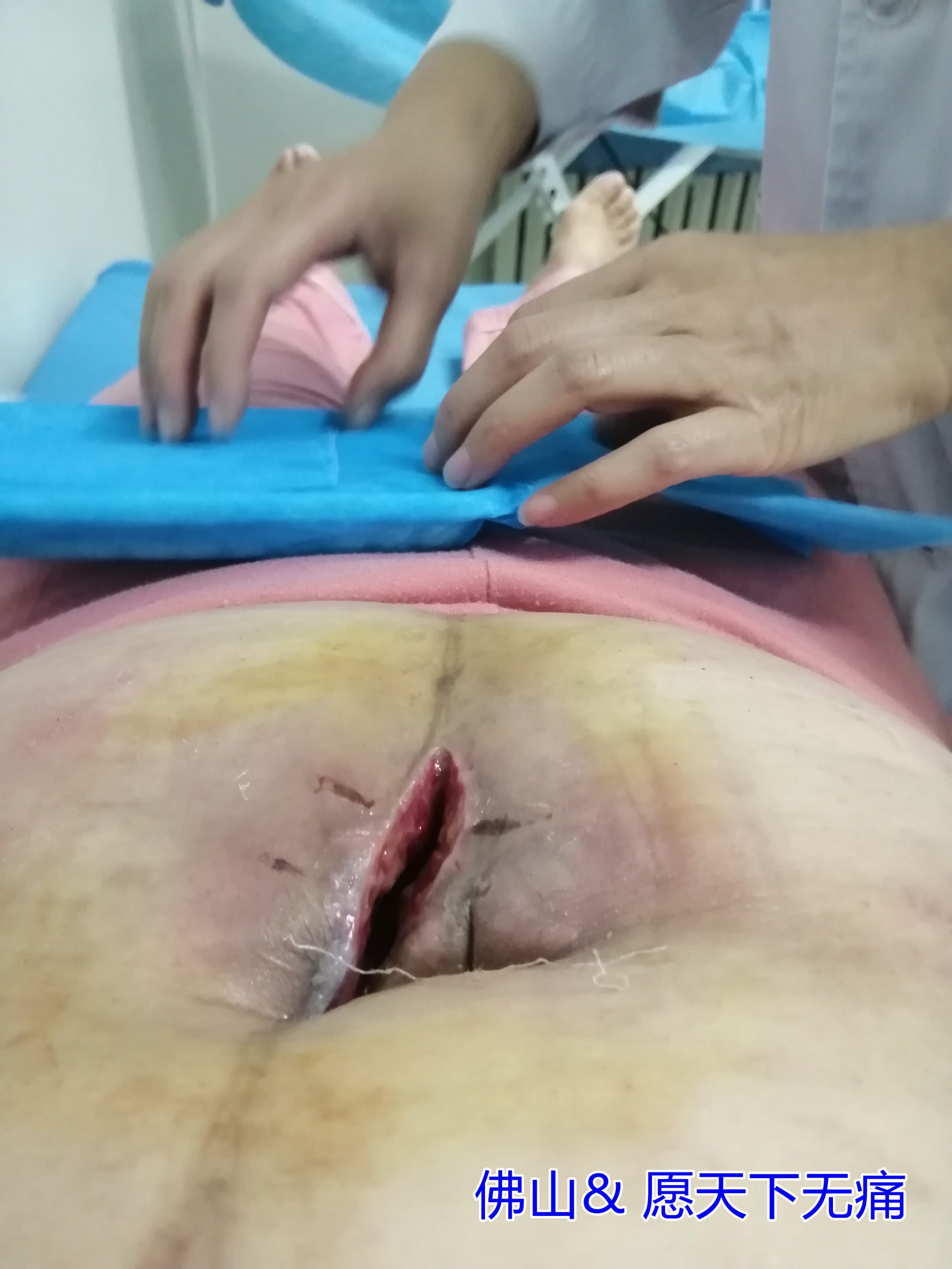 原始点调理卵巢癌术后伤口不愈合案例(邢秀娟) - 妇产   - 佛山市愿天下无痛健康管理服务有限公司