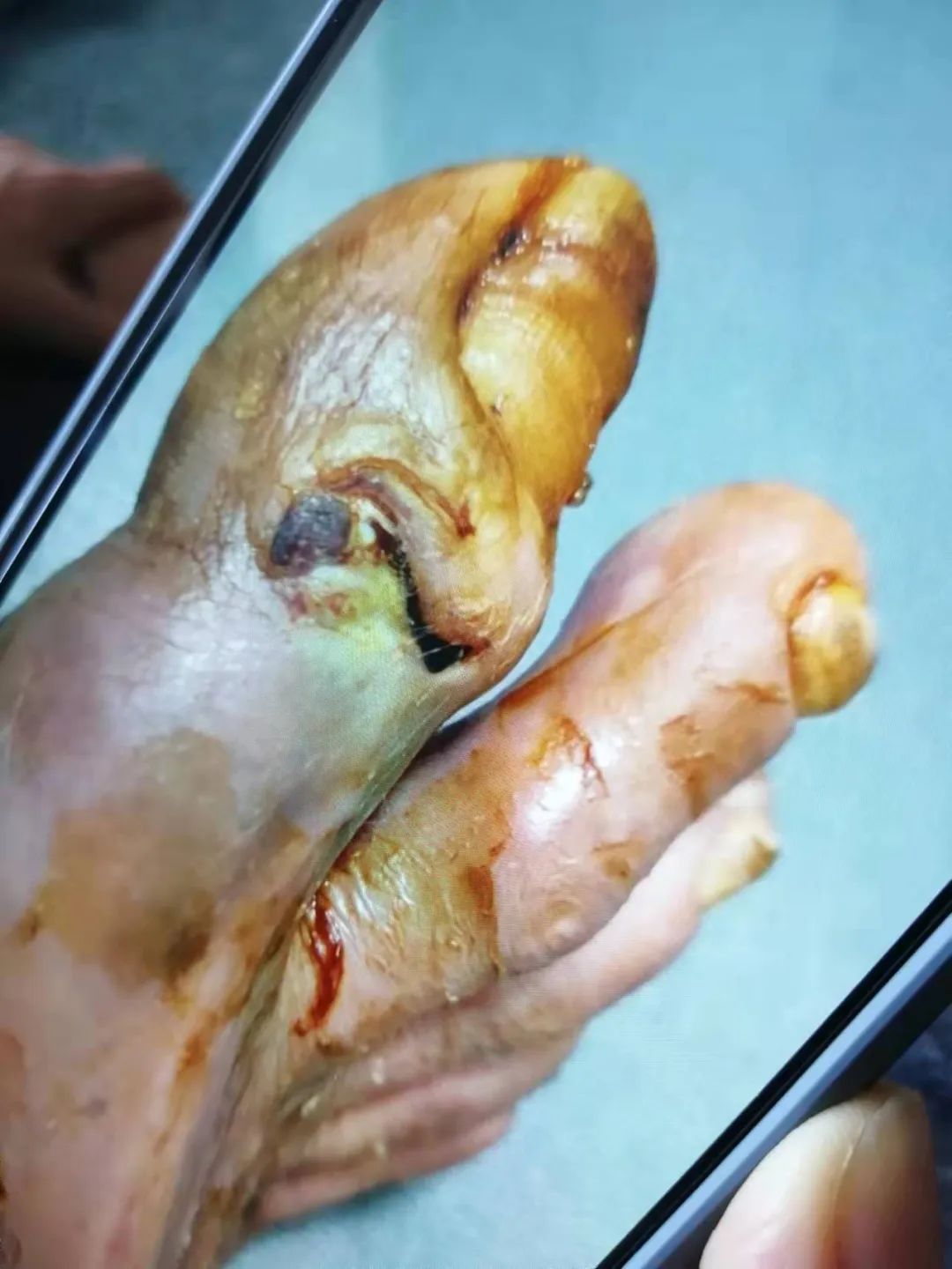 糖尿病案例 糖尿病案例