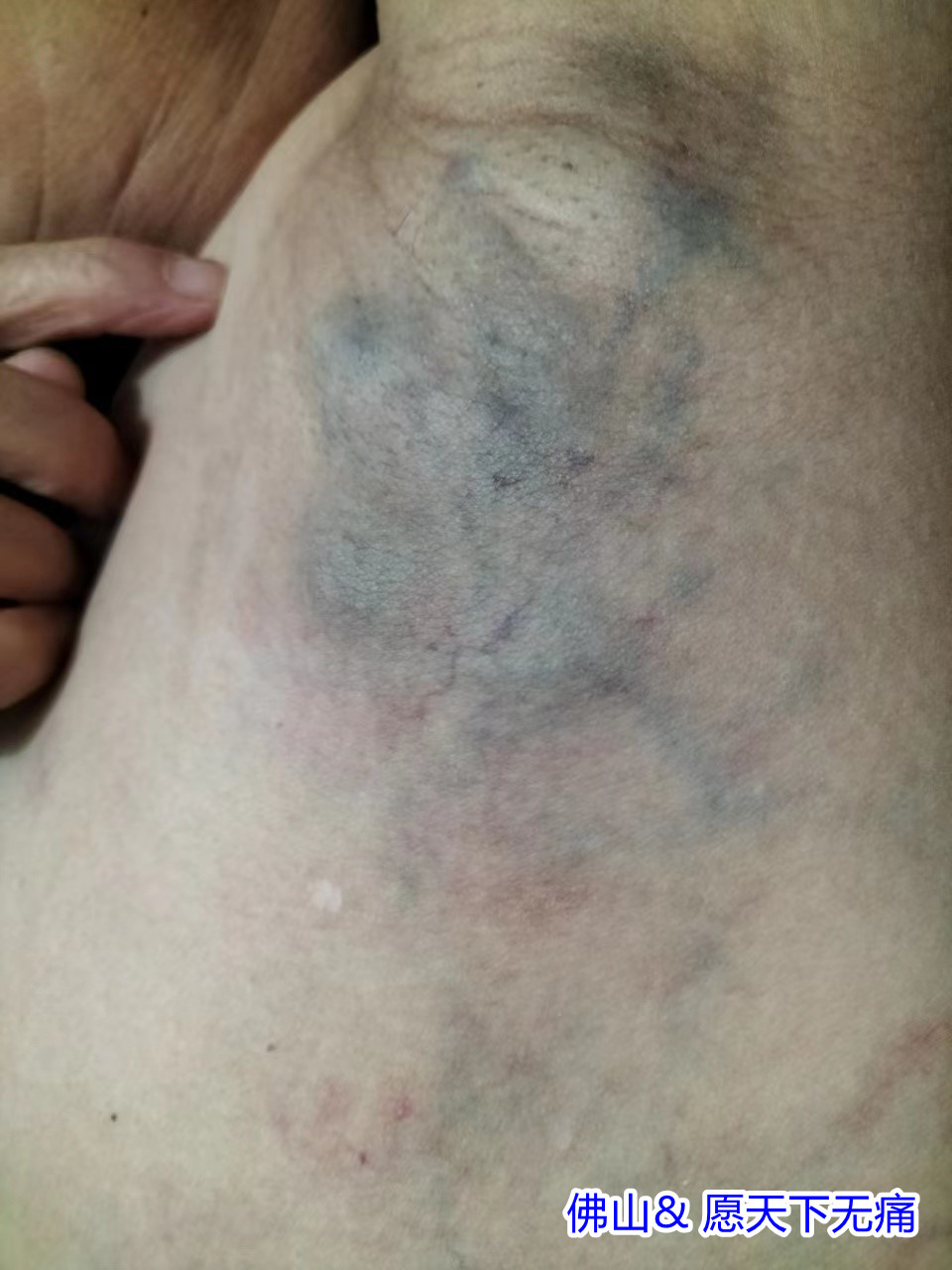原始点腋下淤青静脉曲张结节，乳腺痛等多处疼痛案例(焦小爱) - 皮肤 - 佛山市愿天下无痛健康管理服务有限公司-原始点全球同学网