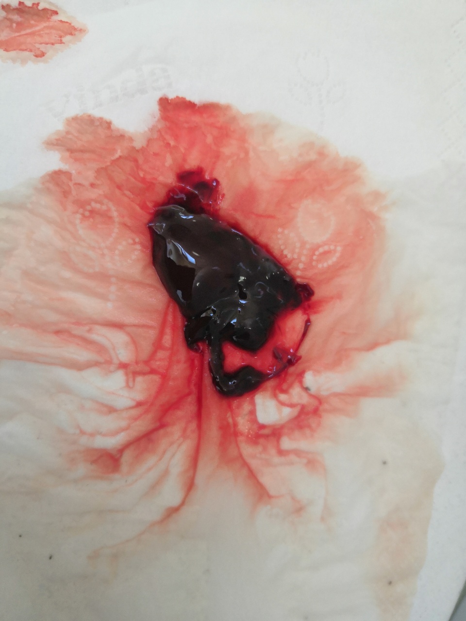 原始点调理胎死腹中案例 - 妇产   - 佛山市愿天下无痛健康管理服务有限公司