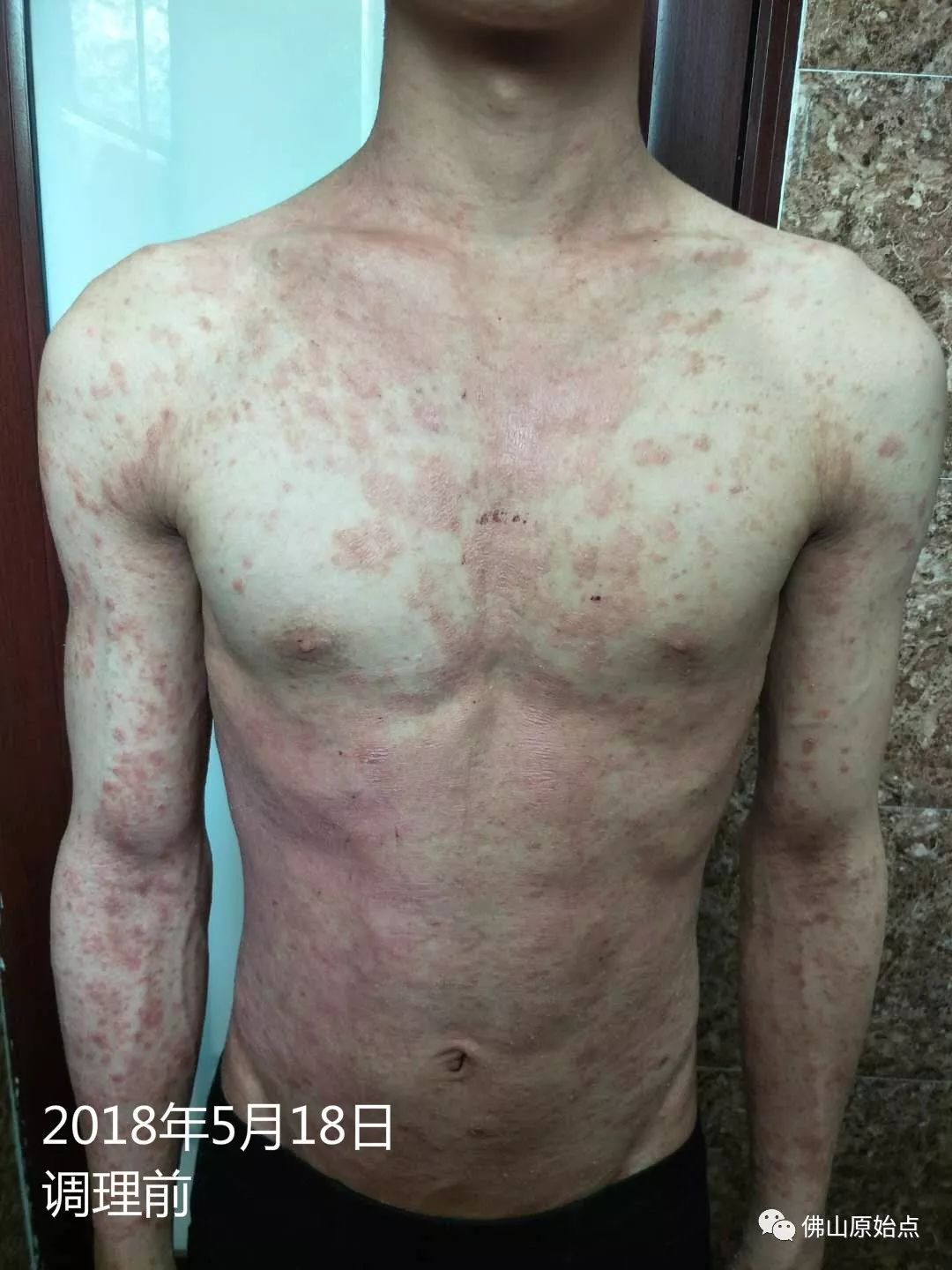 原始点调理严重牛皮癣及静脉曲张：84天完好如初 - 皮肤 - 佛山市愿天下无痛健康管理服务有限公司