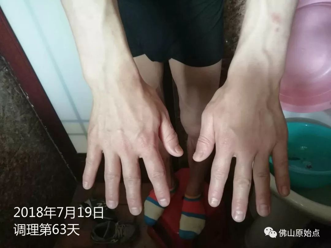 原始点调理严重牛皮癣及静脉曲张：84天完好如初 - 皮肤 - 佛山市愿天下无痛健康管理服务有限公司