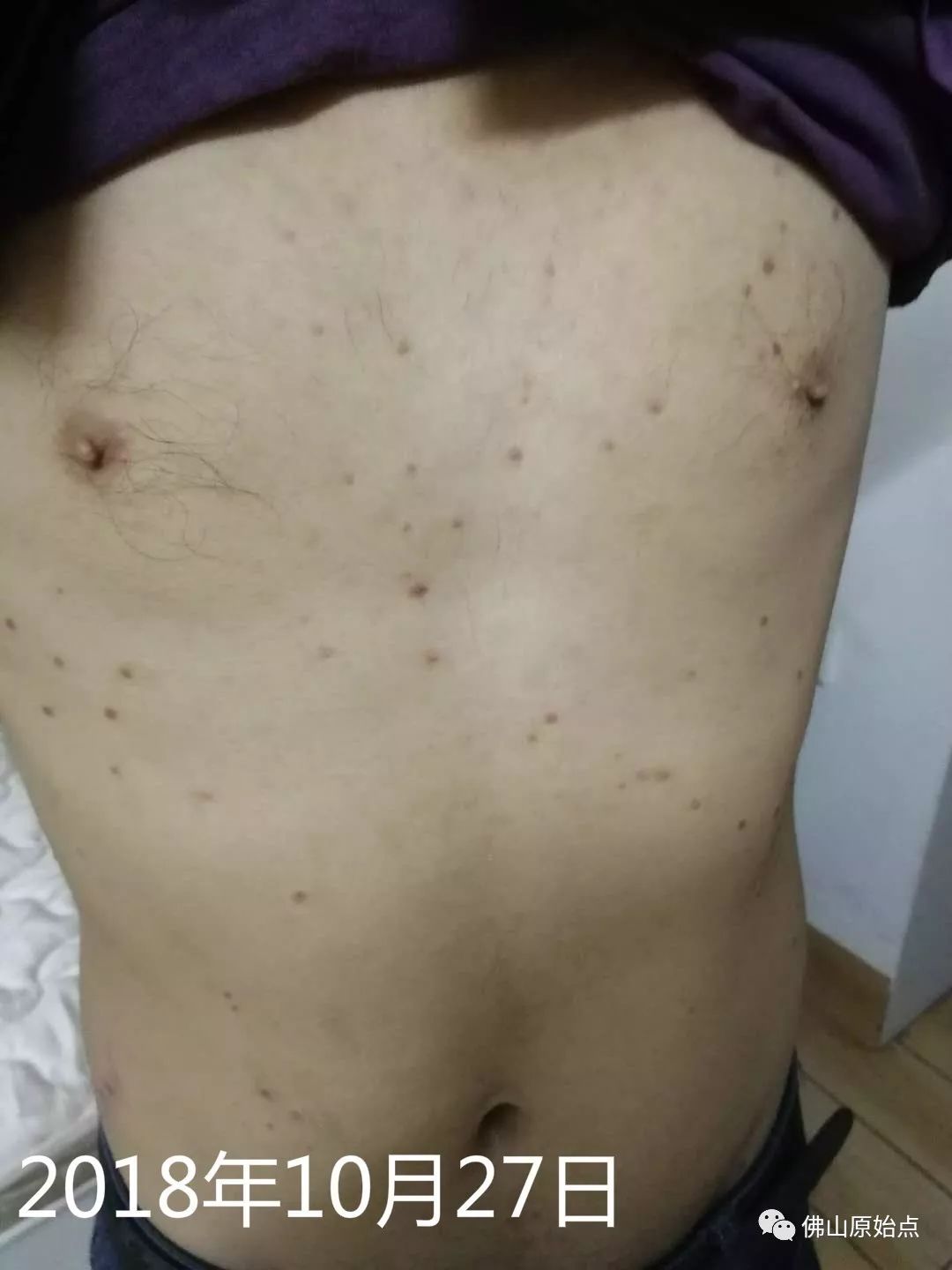 原始点调理牛皮癣案例 - 皮肤 - 佛山市愿天下无痛健康管理服务有限公司