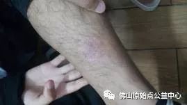 原始点调理九年史牛皮癣：二十天大变化 - 皮肤 - 佛山市愿天下无痛健康管理服务有限公司