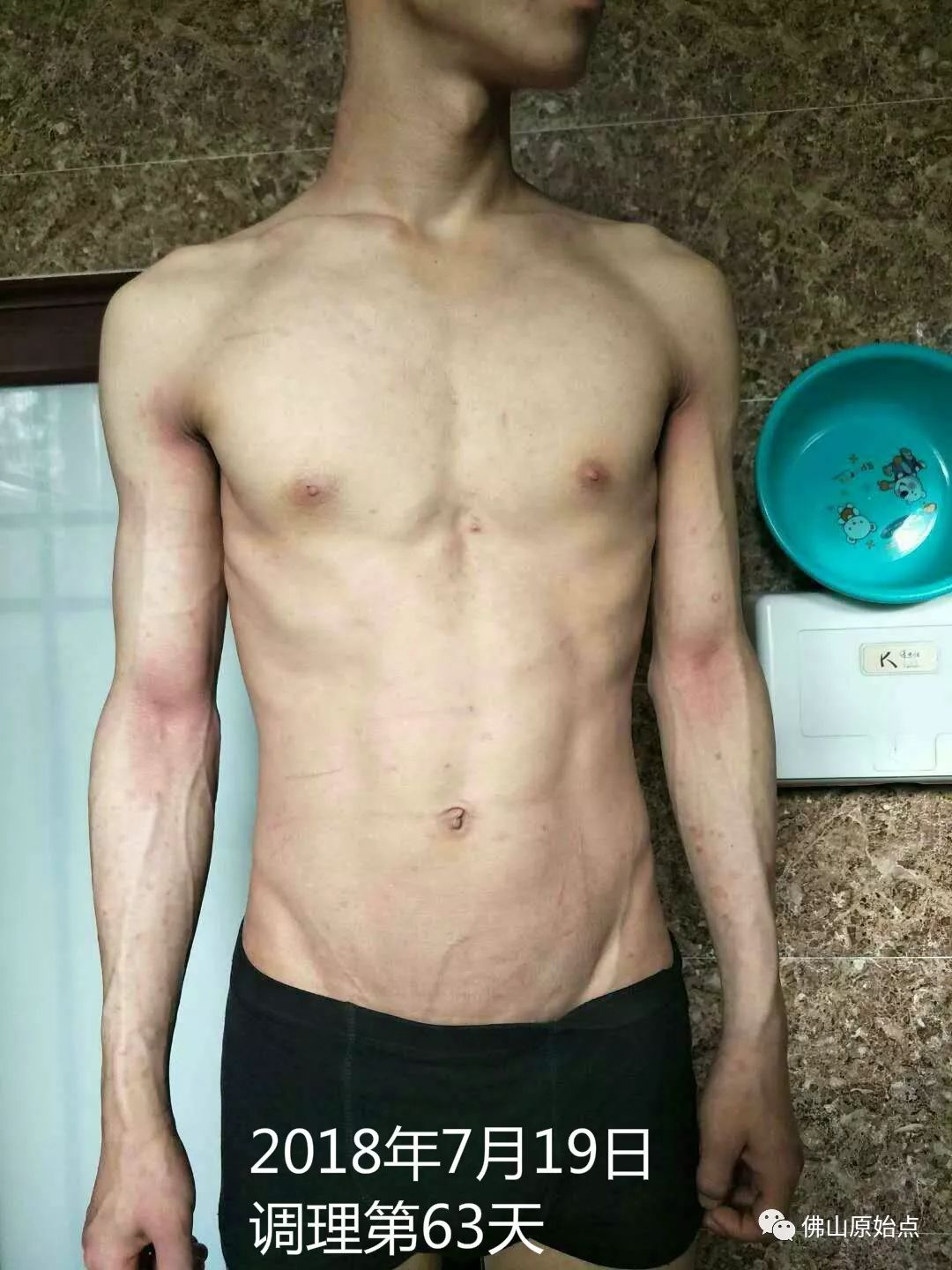 原始点调理严重牛皮癣及静脉曲张：84天完好如初 - 皮肤 - 佛山市愿天下无痛健康管理服务有限公司