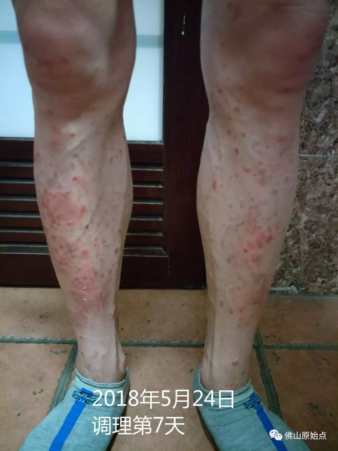 原始点调理严重牛皮癣及静脉曲张：84天完好如初 - 皮肤 - 佛山市愿天下无痛健康管理服务有限公司