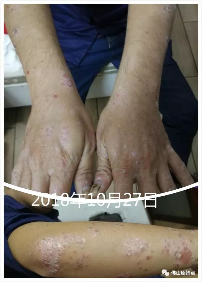 原始点调理牛皮癣案例 - 皮肤 - 佛山市愿天下无痛健康管理服务有限公司