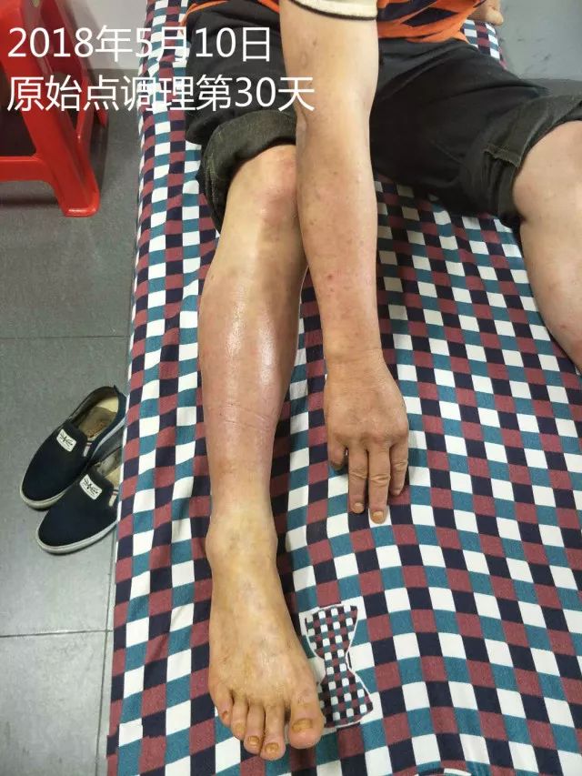 原始点调理十五年病史牛皮癣：30天大变样 - 皮肤 - 佛山市愿天下无痛健康管理服务有限公司