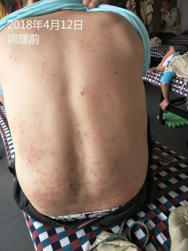 原始点调理十五年病史牛皮癣：30天大变样 - 皮肤 - 佛山市愿天下无痛健康管理服务有限公司