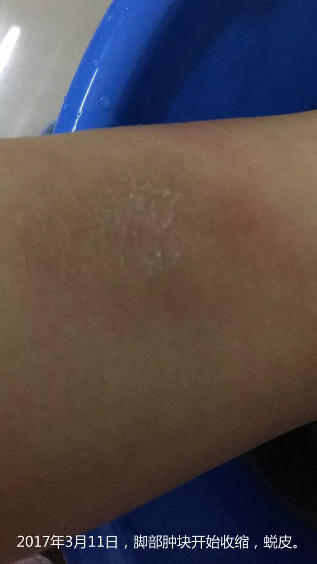 原始点调理乳房溃烂：一位德国媳妇飞越半球的原始点求医经历 - 乳腺增生  乳腺癌 - 佛山市愿天下无痛健康管理服务有限公司