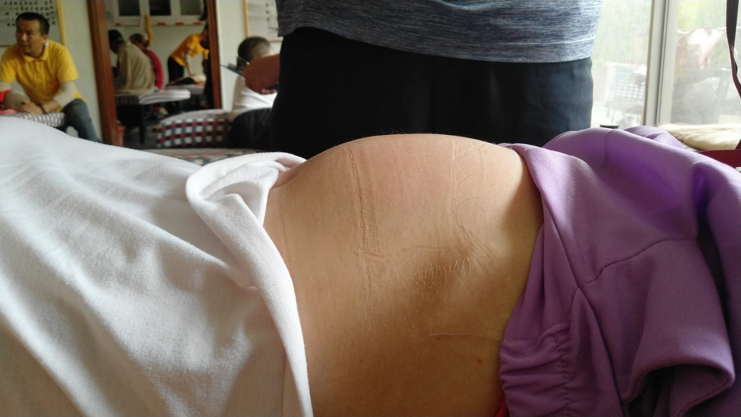 原始点调理卵巢囊肿案例 - 妇产   - 佛山市愿天下无痛健康管理服务有限公司