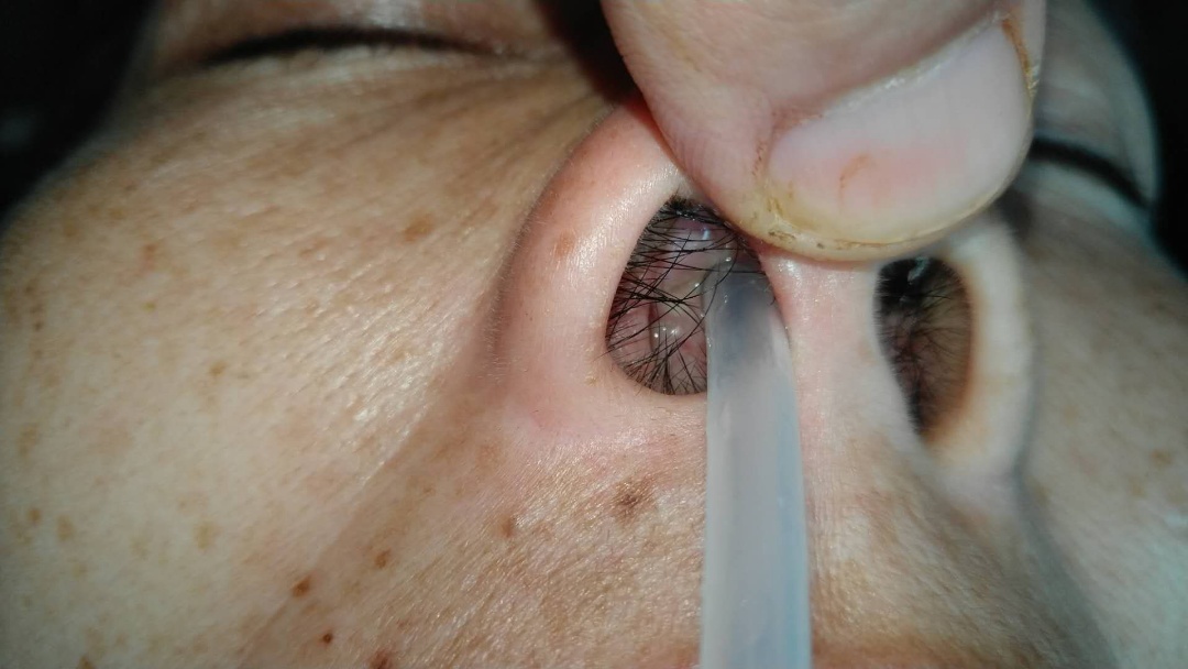 原始点调理鼻息肉案例 - 头颈  五官 - 佛山市愿天下无痛健康管理服务有限公司