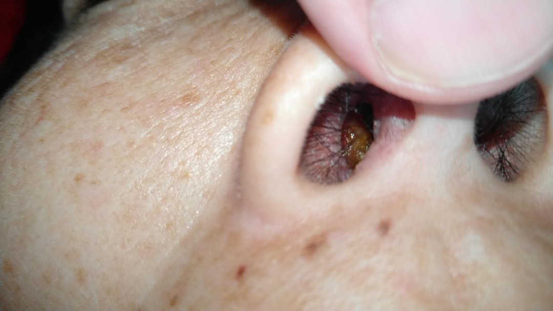 原始点调理鼻息肉案例 - 头颈  五官 - 佛山市愿天下无痛健康管理服务有限公司