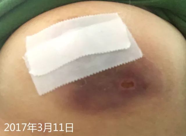 原始点调理乳房溃烂：一位德国媳妇飞越半球的原始点求医经历 - 乳腺增生  乳腺癌 - 佛山市愿天下无痛健康管理服务有限公司