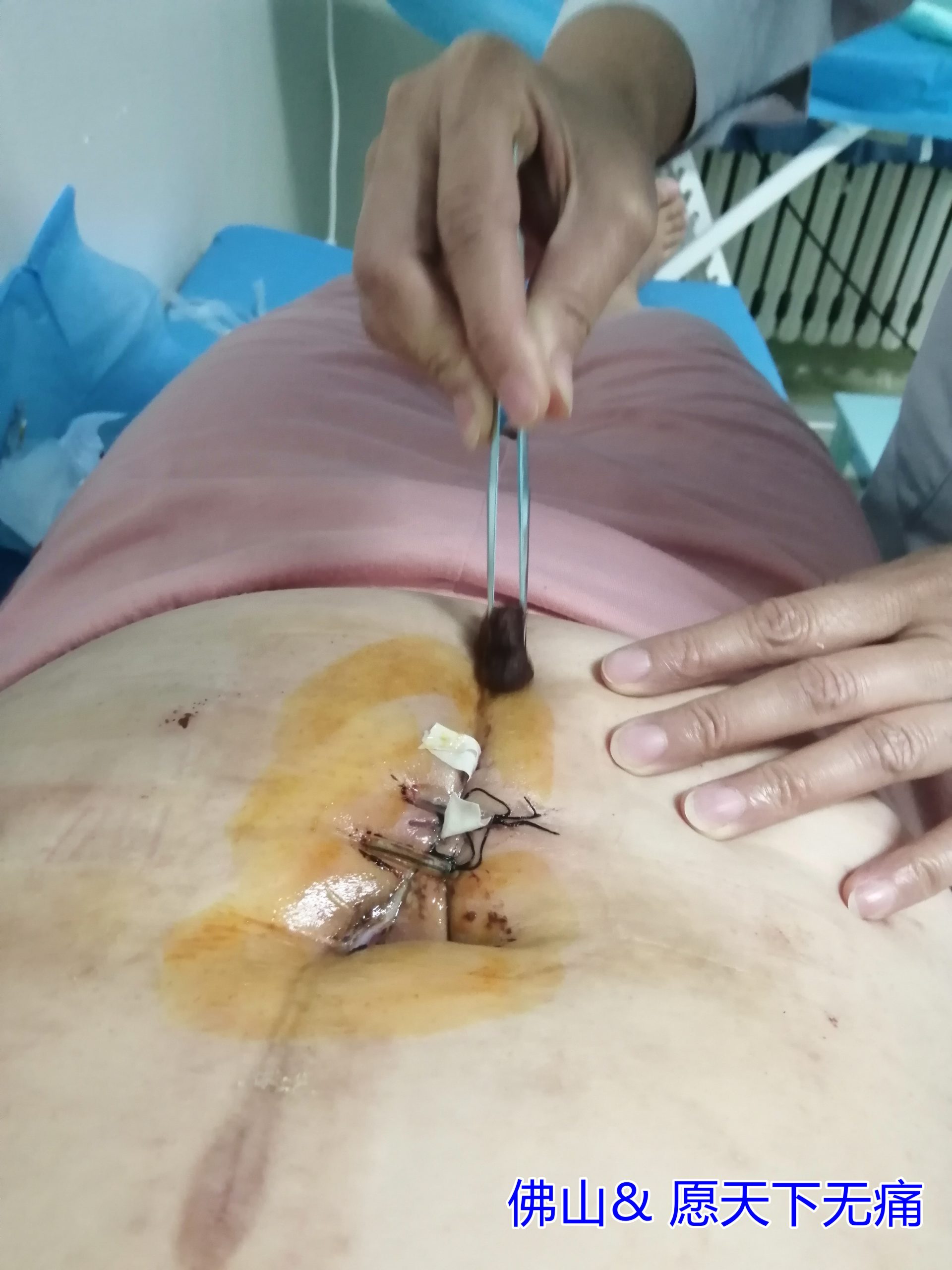 原始点调理卵巢癌术后伤口不愈合案例(邢秀娟) - 妇产   - 佛山市愿天下无痛健康管理服务有限公司-原始点全球同学网