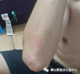 原始点调理九年史牛皮癣：二十天大变化 - 皮肤 - 佛山市愿天下无痛健康管理服务有限公司-原始点全球同学网