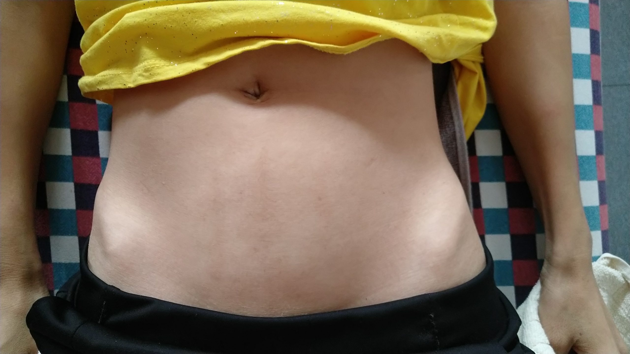 原始点调理卵巢囊肿案例 - 妇产   - 佛山市愿天下无痛健康管理服务有限公司