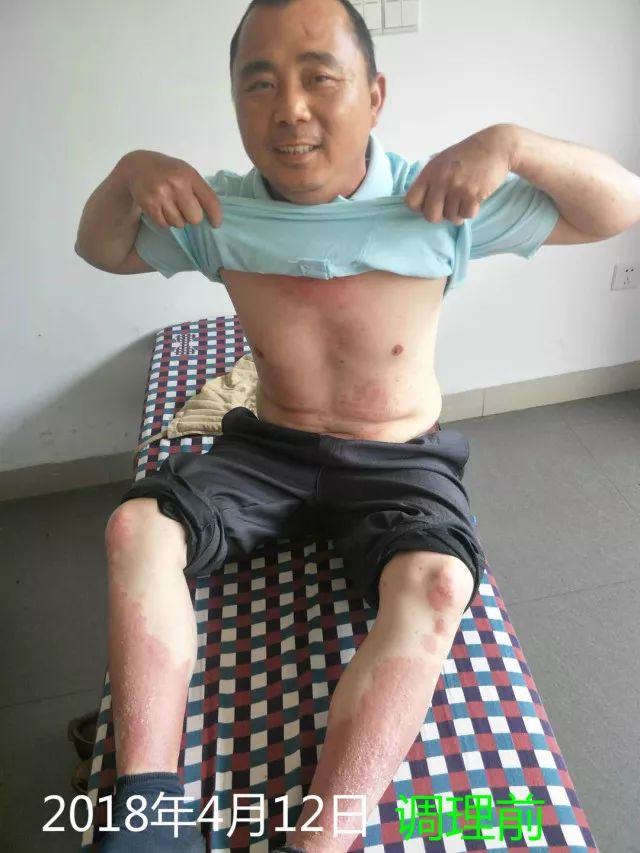 原始点调理十五年病史牛皮癣：30天大变样 - 皮肤 - 佛山市愿天下无痛健康管理服务有限公司