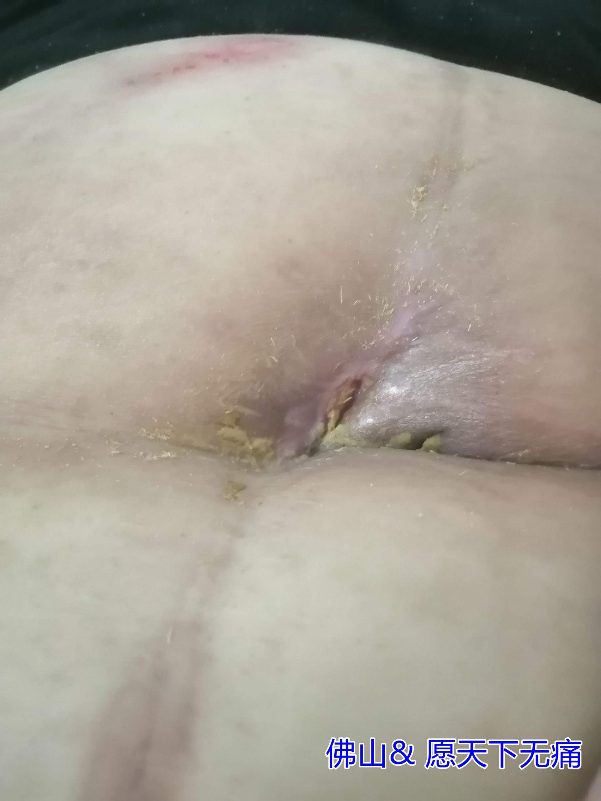 原始点调理卵巢癌术后伤口不愈合案例(邢秀娟) - 妇产   - 佛山市愿天下无痛健康管理服务有限公司