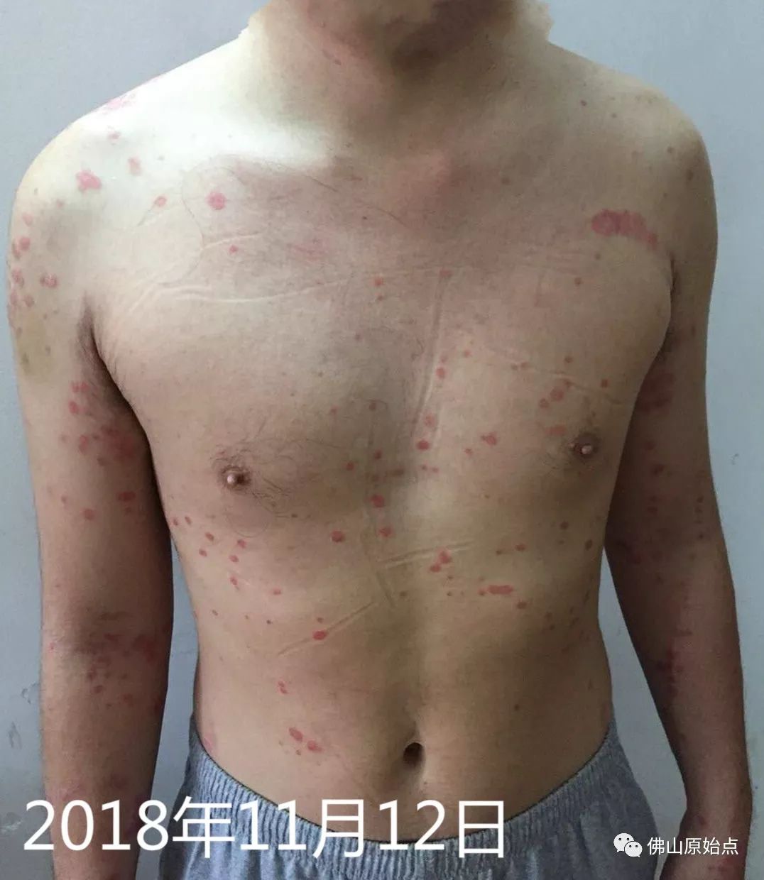 原始点调理牛皮癣案例 - 皮肤 - 佛山市愿天下无痛健康管理服务有限公司