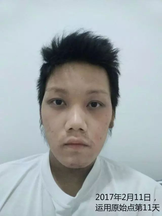 原始点21天调理23年严重湿疹案例 - 皮肤 - 佛山市愿天下无痛健康管理服务有限公司