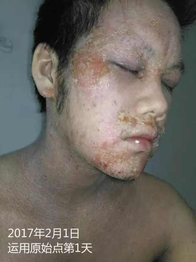 原始点21天调理23年严重湿疹案例 - 皮肤 - 佛山市愿天下无痛健康管理服务有限公司