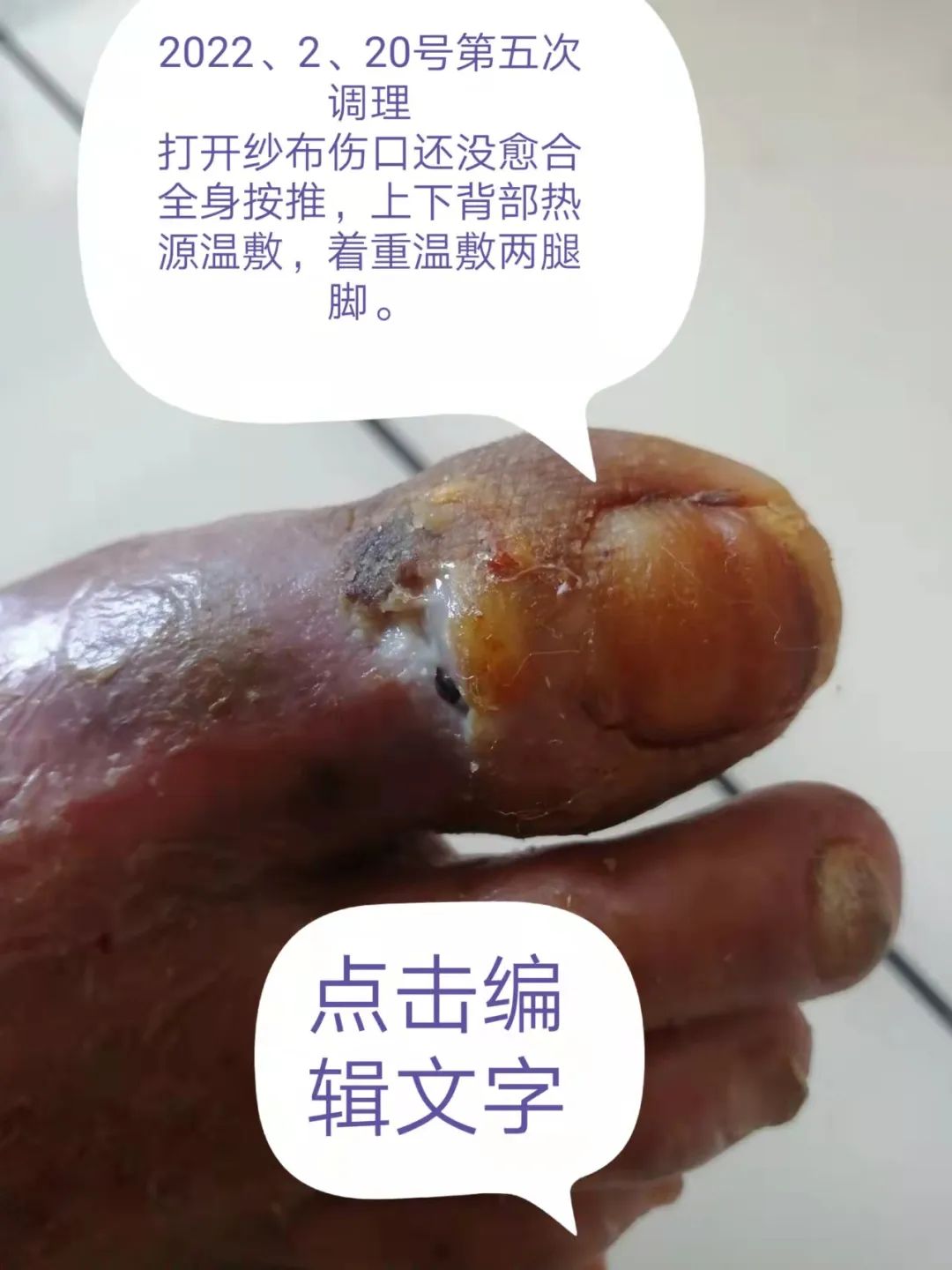 糖尿病案例 糖尿病案例