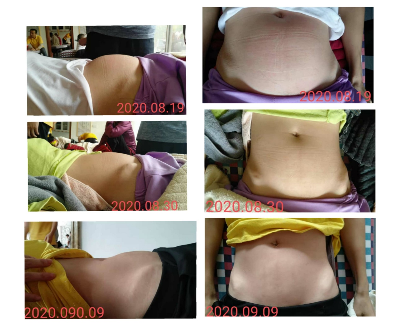 原始点调理卵巢囊肿案例 - 妇产   - 佛山市愿天下无痛健康管理服务有限公司