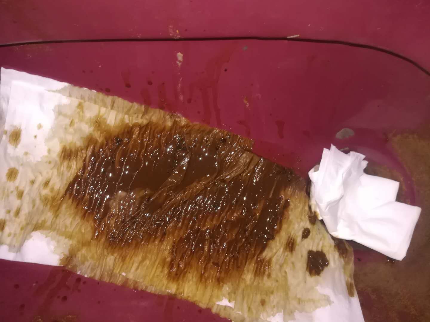 原始点调理卵巢囊肿案例 - 妇产   - 佛山市愿天下无痛健康管理服务有限公司