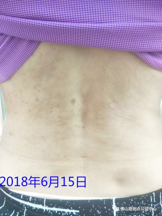 原始点调理带状疱疹：轻松快捷效果好 - 皮肤 - 佛山市愿天下无痛健康管理服务有限公司