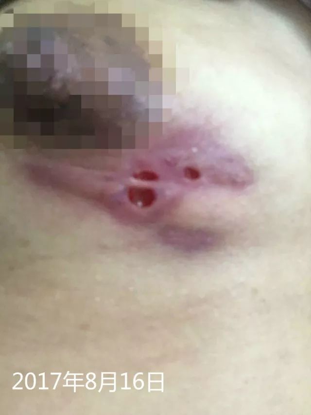 原始点调理乳房溃烂：一位德国媳妇飞越半球的原始点求医经历 - 乳腺增生  乳腺癌 - 佛山市愿天下无痛健康管理服务有限公司