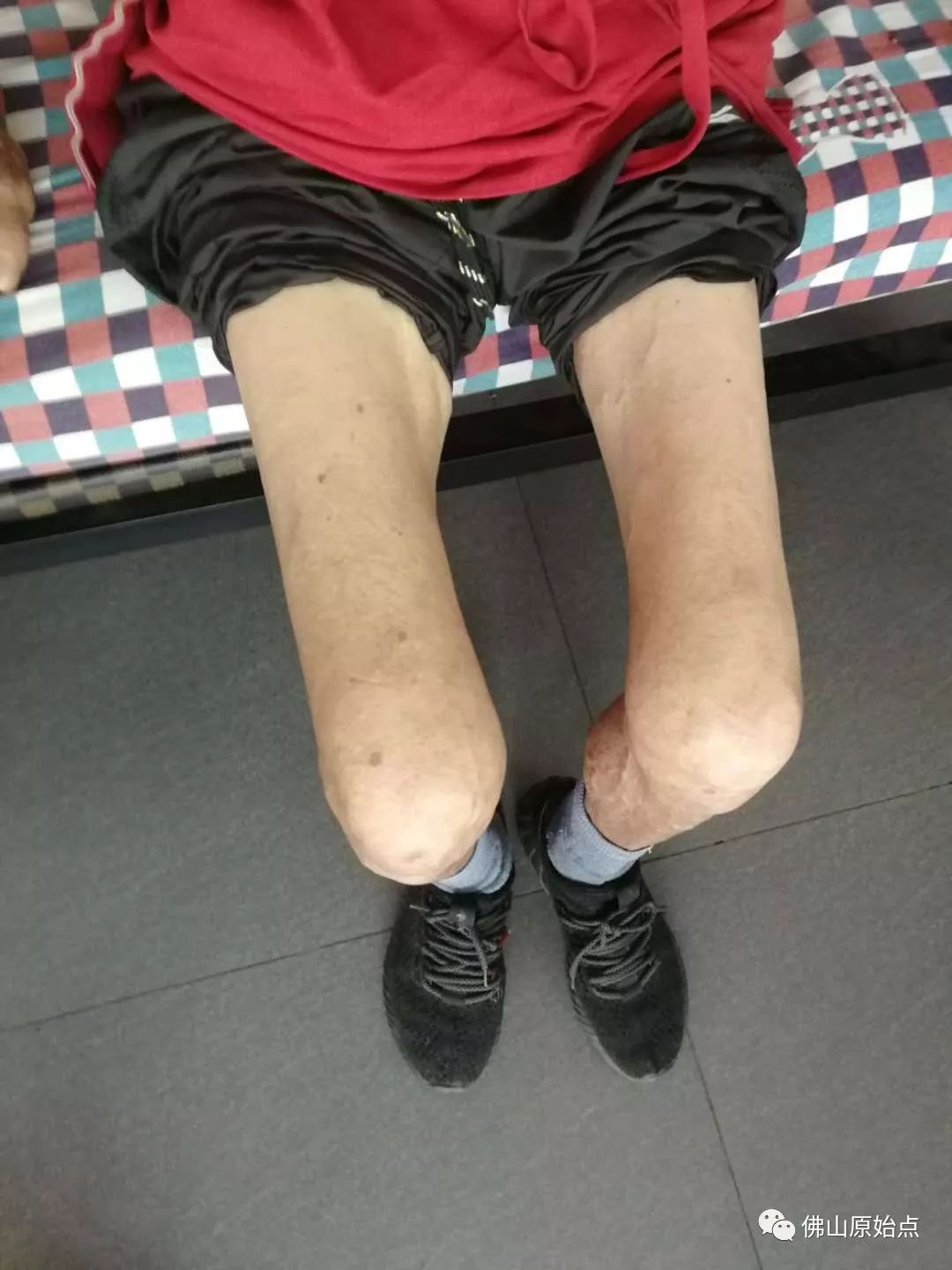 原始点调理肺肿瘤案例 - 肺结核  肺腺癌  肺癌 - 佛山市愿天下无痛健康管理服务有限公司